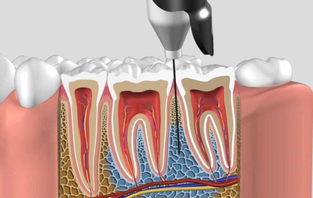 QuickSleeper 6A - A1 Anestesisystem 