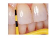 Hu-Friedy Colorvue Tips #11 12stk