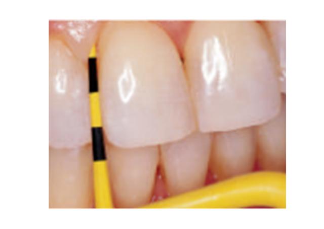 Hu-Friedy Colorvue Tips #11 12stk