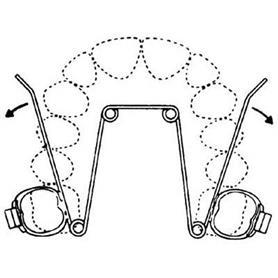 RM A00511 Maxillary Quad Helix Unit Str 2 3/pk