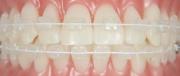 FO 207-0935 Titanol BioCosmetic .014 Ukj Coated 