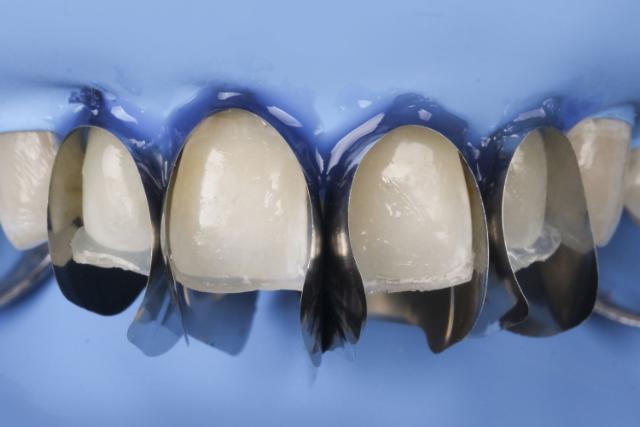 Unica Anterior 6911 Minideep matrise 12stk